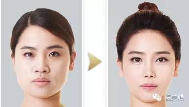 蛋白線面部提升注意事項(xiàng)