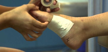 節(jié)扎后有什么注意事項