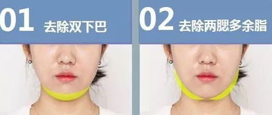 臉部吸脂手術(shù)注意事項