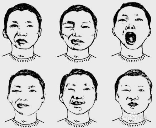 面癱,治愈,注意事項(xiàng)