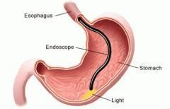 做無痛胃鏡需要注意什么事項,無痛胃鏡要注意什么,做完無痛胃鏡和腸鏡后要注意事項