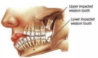智齒切肉后注意事項,拔智齒注意事項與禁忌,女性拔智齒注意事項
