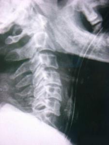 頸椎,骨折,翻身,注意事項