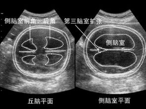 注意事項(xiàng),早孕