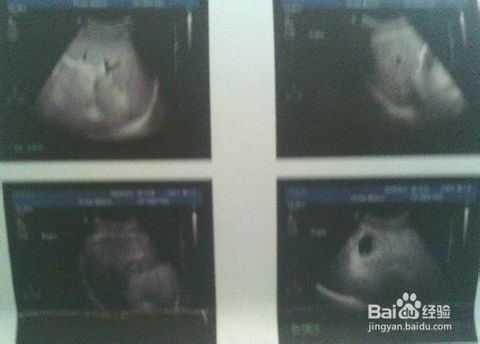 懷孕照b超注意事項