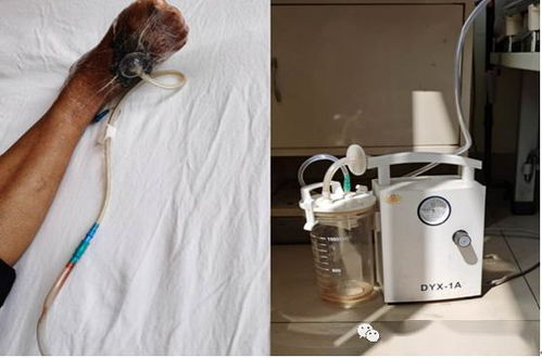 注意事項,負(fù)壓,吸引,vsd