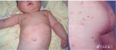 兒童得了尋麻疹的注意事項(xiàng),慢性尋麻疹的注意事項(xiàng),急性尋麻疹注意事項(xiàng)