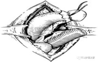 術(shù)后,注意事項,患者,腸造瘺