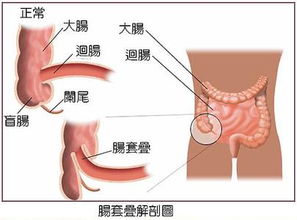 孩子腸套疊后注意事項(xiàng)