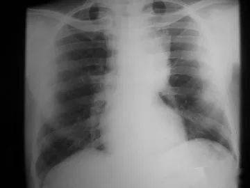 胸腺癌飲食注意事項(xiàng),胸腺癌術(shù)后注意事項(xiàng),胸腺癌放化療效果好嗎