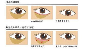 眼袋,注意事項(xiàng),手術(shù)