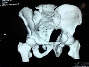 髖關(guān)節(jié)復(fù)位后注意事項(xiàng),頸椎復(fù)位后的注意事項(xiàng),腰復(fù)位后需要注意事項(xiàng)