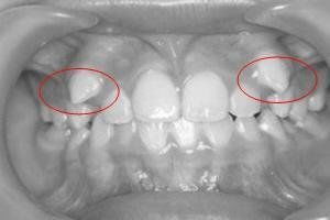 拔多生牙前注意事項