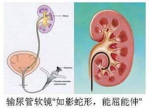 輸尿管軟鏡術(shù)后注意事項(xiàng)