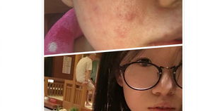 臉部過敏發(fā)注意事項