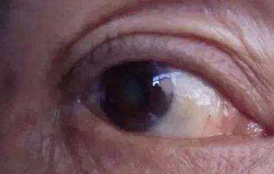 輕微白內障注意事項