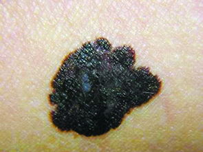 黑色素,切除,注意事項(xiàng)