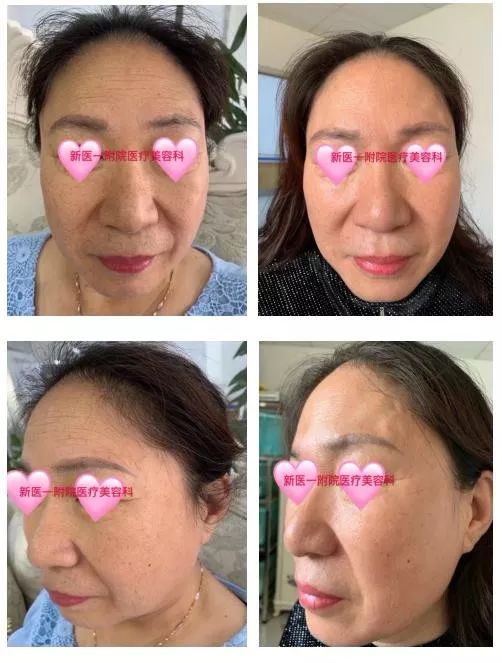 中胚層療法的注意事項