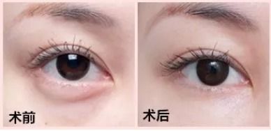 做了內(nèi)切眼袋注意事項(xiàng)