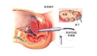 試管嬰兒取卵前后的注意事項,試管嬰兒取卵術后注意事項,試管嬰兒取卵注意事項及經(jīng)驗