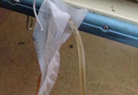 老人插尿管注意事項(xiàng)