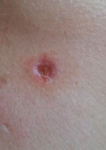 黑痣,注意事項(xiàng)