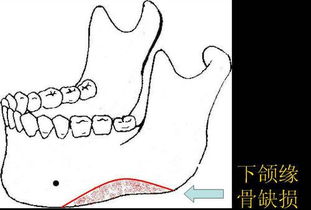 心室,缺損,注意事項(xiàng)