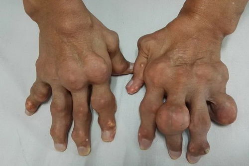 皮肌炎,注意事項(xiàng)