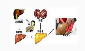 肝癌早期生活注意事項(xiàng)