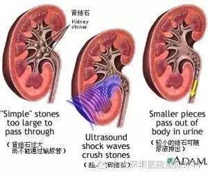 沖擊波,碎石,體外,注意事項(xiàng)