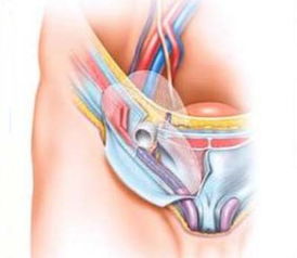 疝氣,術(shù)后,修補(bǔ),注意事項(xiàng)