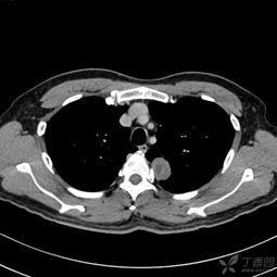 神經(jīng)鞘瘤術(shù)后注意事項(xiàng)