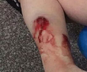 狗咬傷注意事項(xiàng),蛇咬傷注意事項(xiàng),被貓咬傷注意事項(xiàng)