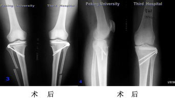 脛骨植骨后的注意事項