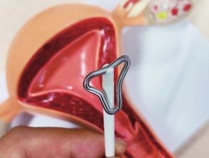 摘掉,注意事項(xiàng),節(jié)育環(huán)