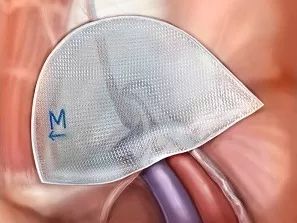 疝氣,術(shù)后,修補(bǔ),注意事項(xiàng)