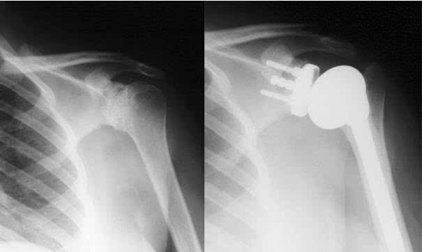 肩關節(jié)基礎知識